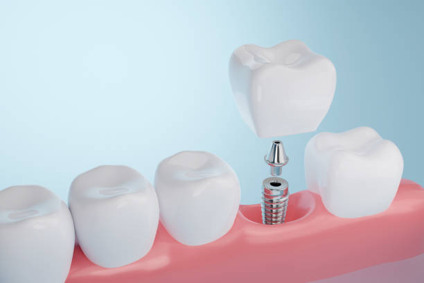 Kaip išvengti dantų implantų atmetimo: 7 moksliniais tyrimais pagrįsti metodai sėkmingam gijimui
